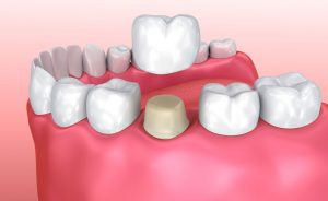 Dental Crowns in Tunbridge Wells