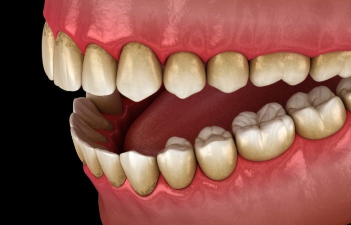 Gingivectomy in Tunbridge Wells - Woodbury Park Dental