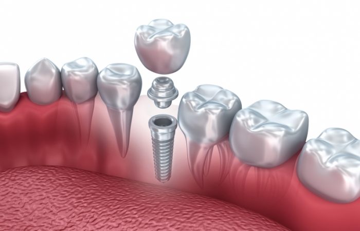 Single Tooth Dental Implant in Tunbridge Wells - Woodbury Park Dental