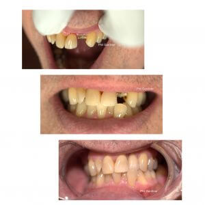 Dental Implants